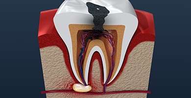 Model of damaged tooth