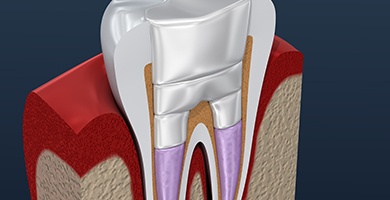 Animation of inside of tooth after retreatment