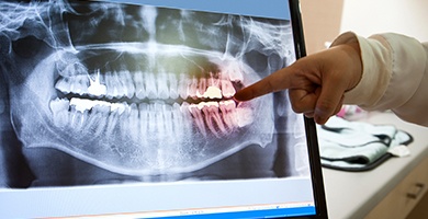 Dental x-rays on computer