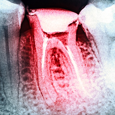 X-ray of root canal treated tooth highlighted red