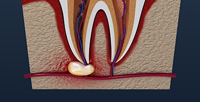 Animation of infection at the tip of a tooth root