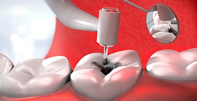 Animation of tooth during root canal therapy