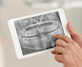 Digital dental x-rays on tablet computer